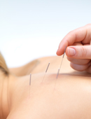  Piekst nicht und hilft gegen Schmerzen: Bei der Akupunktur kommen hauchdünne Nadeln zum Einsatz.